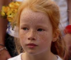 Pin On Freckles Moles 01