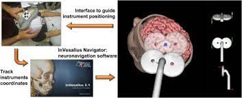 Invesalius generates 3d medical imaging reconstructions based on a sequence of 2d dicom files acquired with ct or mri equipments. Development And Characterization Of The Invesalius Navigator Software For Navigated Transcranial Magnetic Stimulation Sciencedirect
