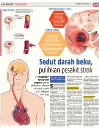 Penderita darah beku bisa saja kehilangan nyawa, apabila kondisinya makin serius, termasuk bila terjadi dibawah lutut. Sedut Darah Beku Pulihkan Pesakit Strok Klik