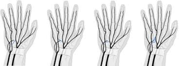 Joining of two tubular structures in order to direct the flow from one structure into the other. Patterns Of Ulnar Nerve Arborization In The Palm Clinical Implications For Nerve Decompression In The Hand And Wrist Journal Of Hand Surgery Global Online