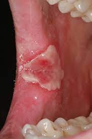 Stds that cause mouth sores symptoms are most commonly due to oral sex. Oral Syphilis A Series Of 5 Cases Journal Of Oral And Maxillofacial Surgery