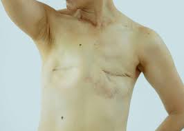 Image result for Mastectomy