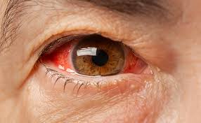 Image result for Glaucoma