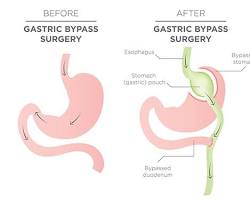 Gastrik anastomoz resmi