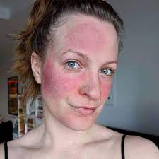 We did not find results for: Bukan Cuma Kemerahan Stop Pemakaian Skincare Jika Ada 6 Tanda Breakout Ini