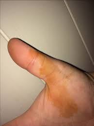 In the case of flat brown or black spots that suddenly appear on your orange cat's nose, lips, and eyelid margins, you may be worrying over nothing. Iodine Colored Blotches On My Hands Glow Community