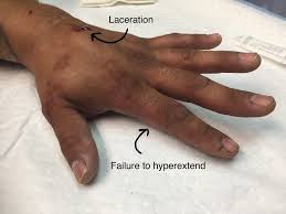 Image result for Hand Extensor Tendon Injury