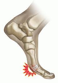 Even though it's linked to artificial surfaces found in most domed stadiums (hence its name), players can get turf toe on grass, as well as any other firm surface. How To Get Rid Of Treat Turf Toe From Dorfman Kinesiology