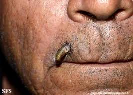 Image result for cornu cutaneum)