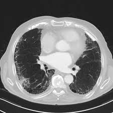 Benign pleural plaques may be seen in profile or en face. Asbestosis Radiology Reference Article Radiopaedia Org
