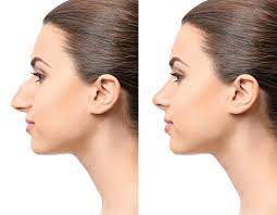 If the wall between the two sides of the nose (septum) is bent or crooked (deviated), the surgeon can also correct it to improve breathing. What To Consider When Selecting A Surgeon For Your Rhinoplasty Revision Houston Sinus Surgery Ear Nose Throat Doctors