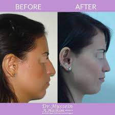 Septorhinoplasty: Correcting Nasal Septum, Nose Shape & Size