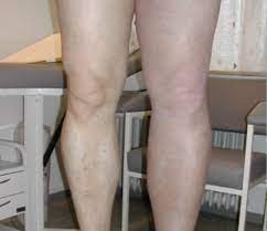 The proteins of the invention are also useful in treatment of thrombosis. Thrombosen Blutgerinnung Kamen Dr Jansen Dr Zimmer