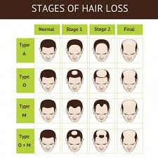 14 Natural Hair Loss Treatments For Men Backed By Science Healthylivingtips Natural Hair Loss Treatment Hair Loss Treatment Vitamins Hair Loss Women