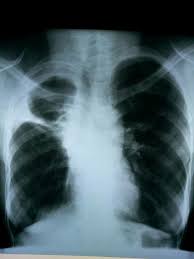 Loculated Pleural Effusion Medical Ultrasound Human Anatomy And Physiology Anatomy And Physiology