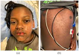 Reactive infectious mucocutaneous eruption