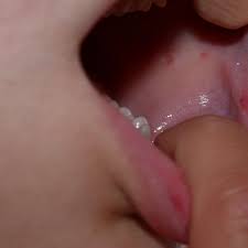 They are the body's natural response to pressure or injury. Recurrent Mouth Ulcers And Canker Sores In Children