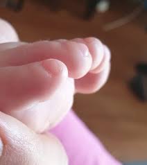 Image result for Clubbing nails feet