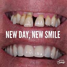 Flexible payment plans for affordable dental implant treatment Dental Implants Walsall Implant Experts Lifetime Lasting