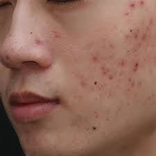 Oily & Acne (For Men)