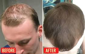 Night willow herb is another name for evening primrose. Emu Oil For Hair Growth How To Use Benefits Reviews