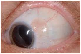 Image result for conjunctival melanoma