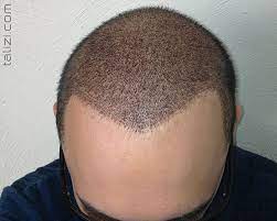 The First Week After Hair Transplantation Hair Transplant Fue Hair Transplant Hair Transplant Surgery