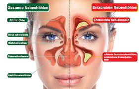 Bei den erregern, die eine sinusitis verursachen, handelt es sich um staphylokokken, streptokokken, pneumokokken oder hämophilus influenzae. Warum Sind Nasensprays Und Antibiotika Bei Einer Sinusitis Unwirksam Gegenverstopftenase De