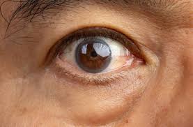 Image result for Cataract