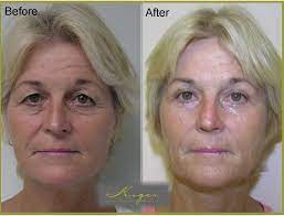Before And After Eyelid Surgery Blepharoplasty Eyelid Surgery Plastic Surgery Surgery