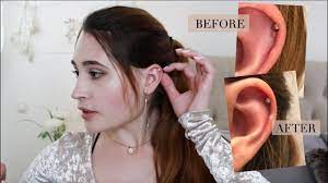 How I Treated My Hypertrophic Scar On Helix Piercing With Photos Youtube