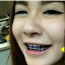 Sama seperti metal, bahan ini cukup nyaman untuk dipakai mengunyah, berbicara dan. Behel Thailand Atas Bawah Shopee Indonesia