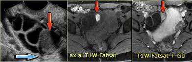 Nonvisualization of the ovaries on pelvic ultrasound: The Radiology Assistant Roadmap To Evaluate Ovarian Cysts