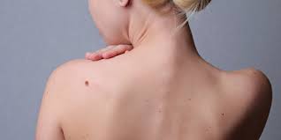 Diagnostik von pilzen auf der haut: Pityriasis Versicolor