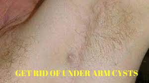 Armpit lumps can be caused due to bacterial or viral infections. How To Get Rid Of Cysts Under Armpit Youtube