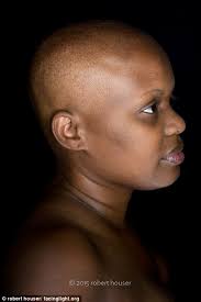 Robert Houser's portraits spotlight cancer patients as they reveal hair  loss and scars