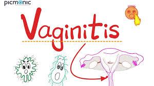 Image result for Vaginitis