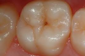 Fissurenversiegelung Gegen Karies Axel Lorke Wurzburg