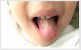 This condition can be spread through saliva, sippy cups, eating utensils, and even shared toys. Acute Primary Herpetic Gingivostomatitis In A Child Strategies For Pain Suppression And To Improve Oral Intake