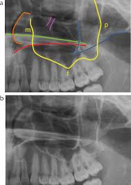 Image result for Maxillary Sinus
