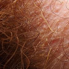 I have gone through your query and can understand your concerns. Trichobacteriosis Axillaris Wikipedia