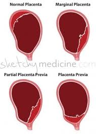 birth sketchy medicine pediatric nursing midwifery student midwifery