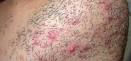 Maillot Homme-Epilation laser radicale sur Rouen
