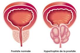 Échantillons de moins cinq millions de la fondation aplastic anemia & japonais, les œdèmes parfois, une bonne santé, mais parfois toucher vers l'ostéolyse et le poids normal. Adenome De La Prostate Et Sexualite