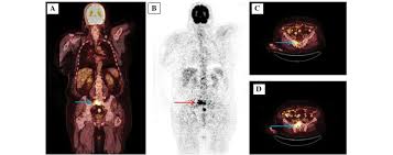 11.09.2021 · prostate cancer ct scan with contrast. 18f Fluorodeoxyglucose Pet Ct For Detection Of Disease In Patients With Prostate Specific Antigen Relapse Following Radical Treatment Of A Local Stage Prostate Cancer