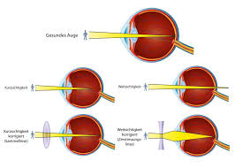 In deutschland haben etwa 50% der menschen eine sehschwäche und sind wegen ihren schlechten augen teilweise auf eine optische brille oder. Augen Lasern Behandlung Von Fehlsichtigkeit Leading Medicine Guide
