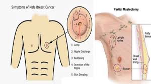 In general, breast cancer causes similar symptoms in men. Why Is Breast Cancer More Common In Females Than Males Comparing Male And Female Breast Cancer Youtube