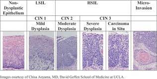 Cin stands for cervical intraepithelial neoplasm. Pin On Cervical Intraepithelial Neoplasia