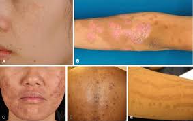 Image result for Postinflammatory Hypopigmentation