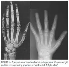 Evaluation Of The Bone Age In 9 12 Years Old Children In